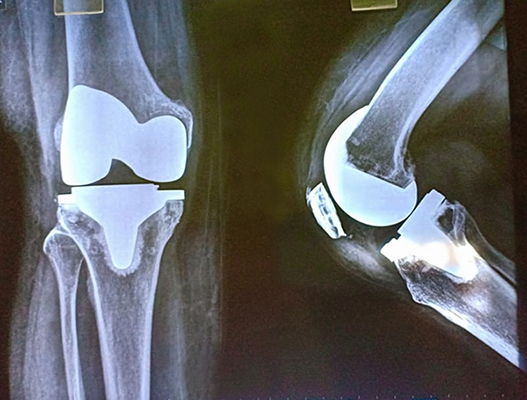 Total Knee Replacement