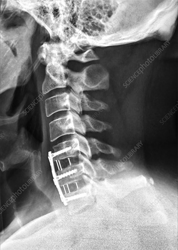 Cervical Spine Surgery