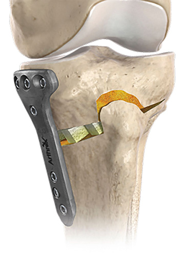 High Tibial Osteotomy