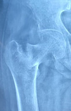 Hip Fractures