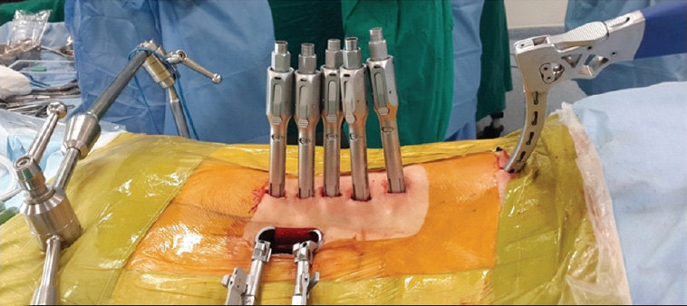 Minimally Invasive Spine Surgery