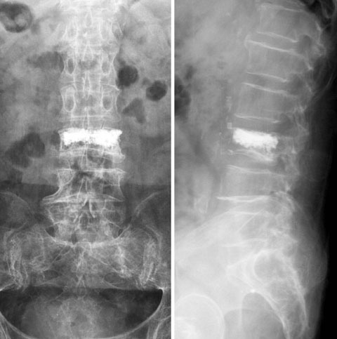 Osteoporosis Related Spinal Surgery