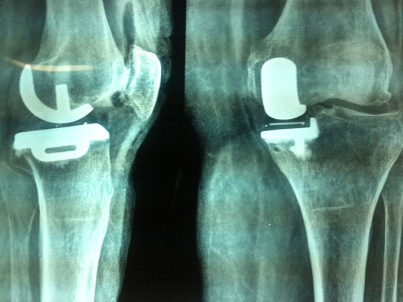 Unicondyler Knee Replacement