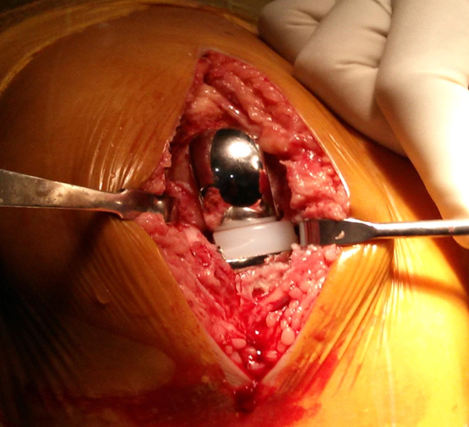 Unicondyler Knee Replacement