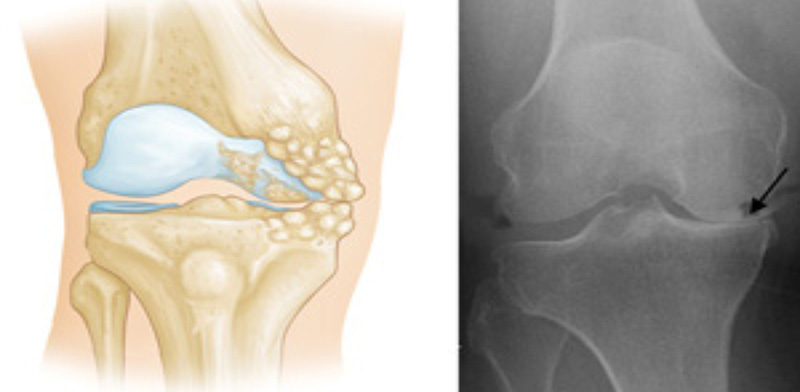 Unicondyler Knee Replacement