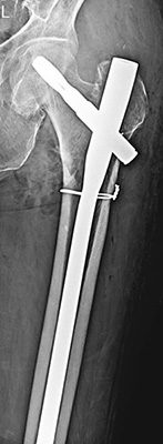 Proximal Femoral Nail