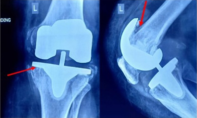 Revision Knee Replacement