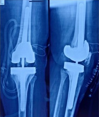 Revision Knee Replacement