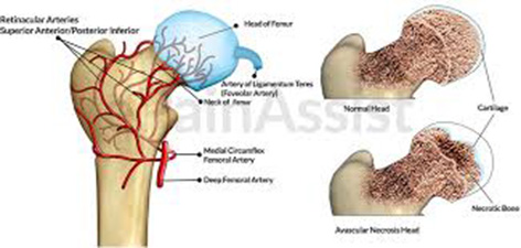 Total Hip Replacement