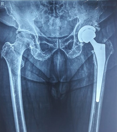 Total Hip Replacement