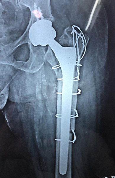 Revision Hip Replacement