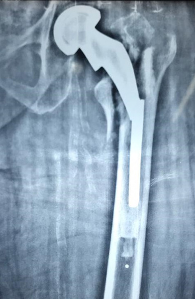 Revision Hip Replacement